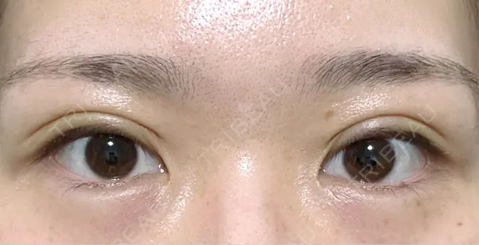 二重埋没 THE FIRST CLINIC 多摩センター院 DAY 2 メイン用