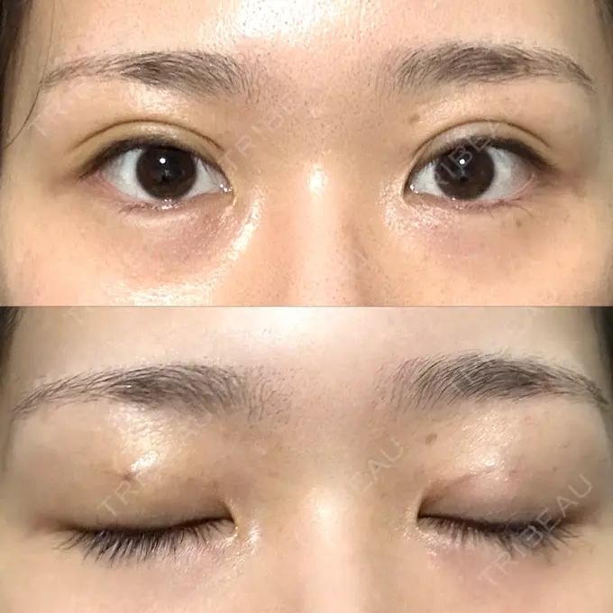 二重埋没 THE FIRST CLINIC 多摩センター院 DAY 3 メイン用