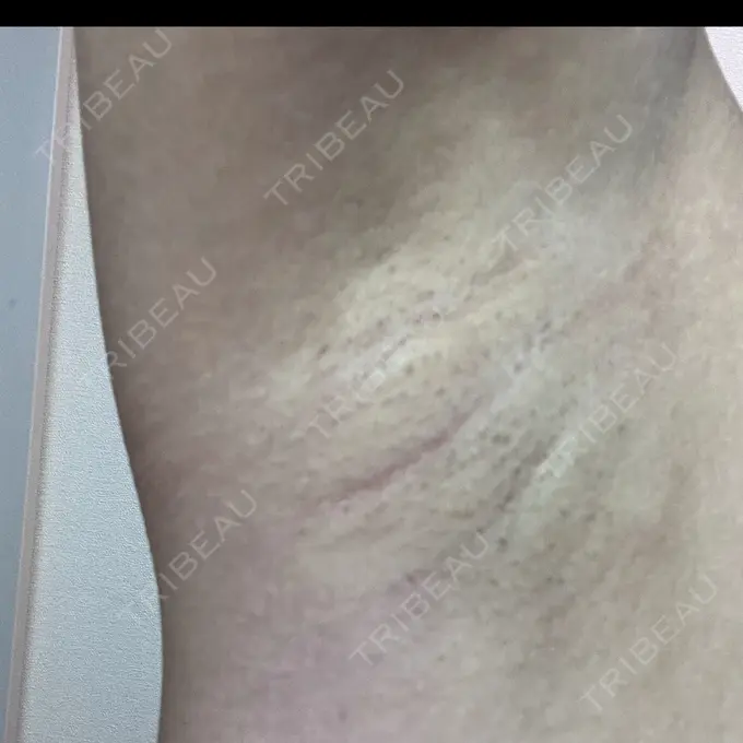 ワキ汗治療（レーザー） Fellez Clinic【フェルズクリニック】 DAY 56 メイン用