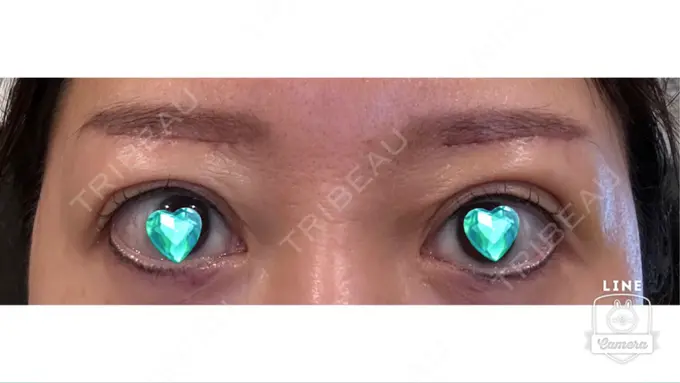 眉下切開 ルーチェクリニック 銀座院 DAY 14 メイン用