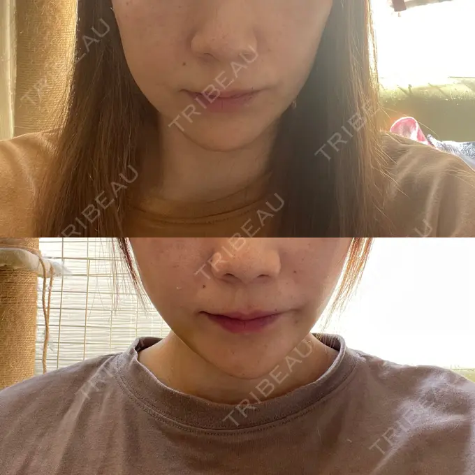 糸リフト / 脂肪吸引（顔） / ボトックス（エラ・小顔） RIVER CLINIC（リバークリニック） DAY 4 メイン用