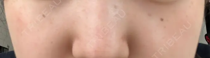 ピコスポット 美容皮膚科エルムクリニック 麻布院 DAY 6 メイン用