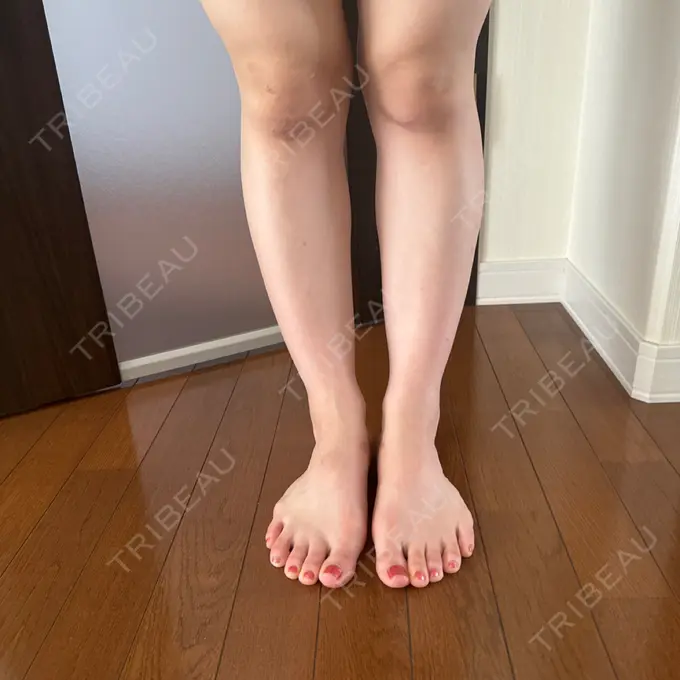 ボトックス（エラ・小顔） / ボトックス（ふくらはぎ） / ボトックス（肩） / ワキ汗治療（ボトックス） / ボトックス（太もも） / ピーリング（ニキビ・毛穴） ルラ美容クリニック 神戸院 AFTER メイン用