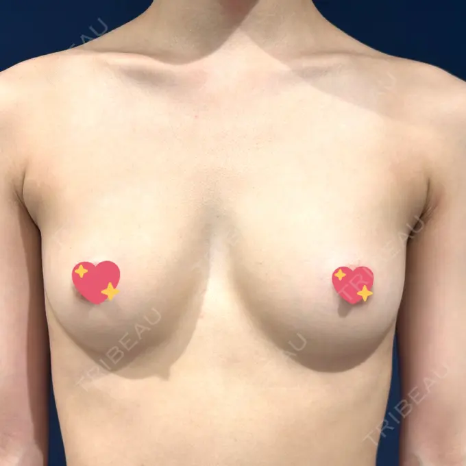 豊胸（脂肪注入） S.T styleクリニック AFTER メイン用
