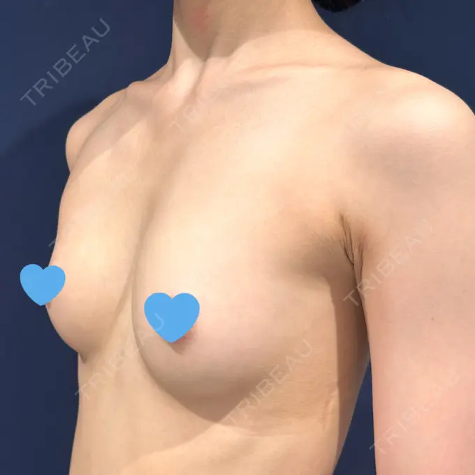 豊胸（脂肪注入） S.T styleクリニック DAY 82 メイン用