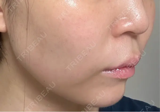 医療痩身（顔） / その他（輪郭） ライブリークリニック 浜松町院 DAY 31 メイン用