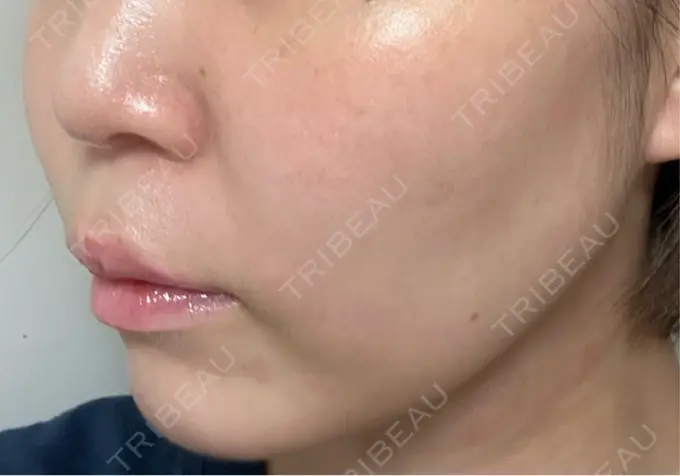 医療痩身（顔） / その他（輪郭） ライブリークリニック 浜松町院 DAY 31 メイン用