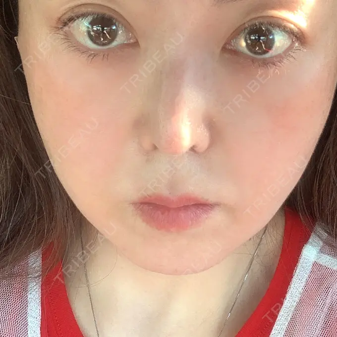 糸リフト / ヒアルロン酸注入（頬） ネビュラクリニック 京都院 DAY 0 メイン用