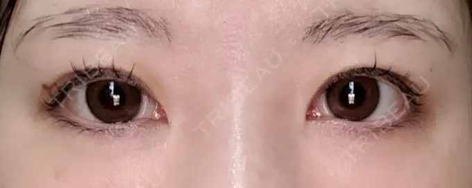 眼瞼下垂（非切開） SOL CLINIC DAY 15 メイン用