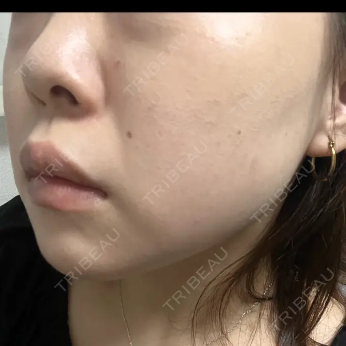 エレクトロポレーション / ルメッカ B-LINE CLINIC 池袋院 DAY 8 メイン用