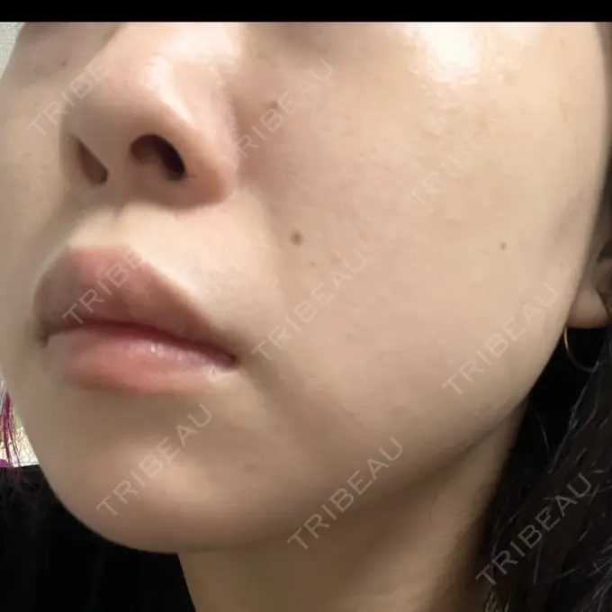 エレクトロポレーション / ルメッカ B-LINE CLINIC 池袋院 DAY 9 メイン用