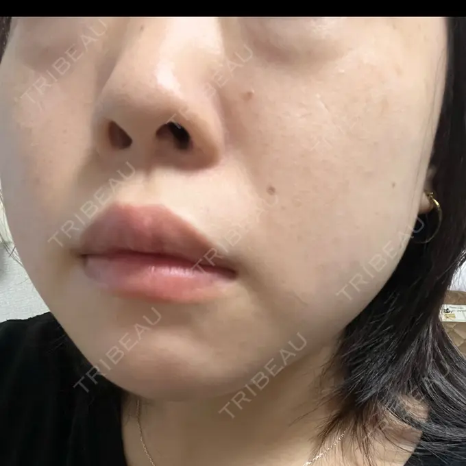 エレクトロポレーション / ルメッカ B-LINE CLINIC 池袋院 DAY 10 メイン用