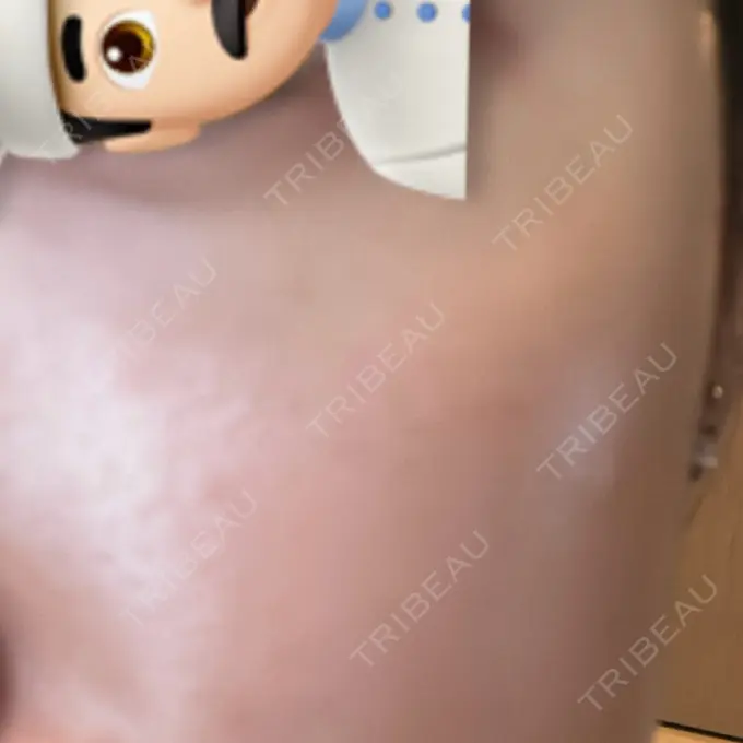 ピーリング（ハリ・ツヤ） 新宿美容外科クリニック 新宿院 AFTER メイン用