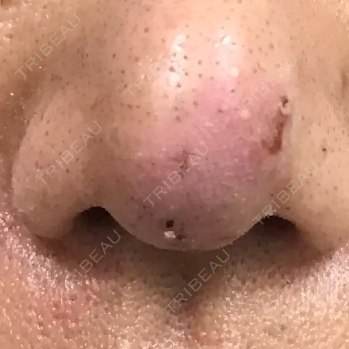 鼻尖形成（切開） 水の森美容クリニック 名古屋院 DAY 6 メイン用