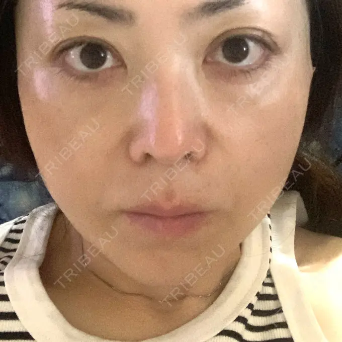 糸リフト / ヒアルロン酸注入（頬） ネビュラクリニック 京都院 DAY 1 メイン用