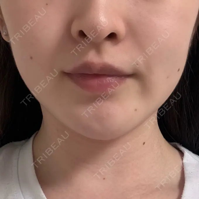 ボトックス（エラ・小顔） BiBiクリニック DAY 3 メイン用