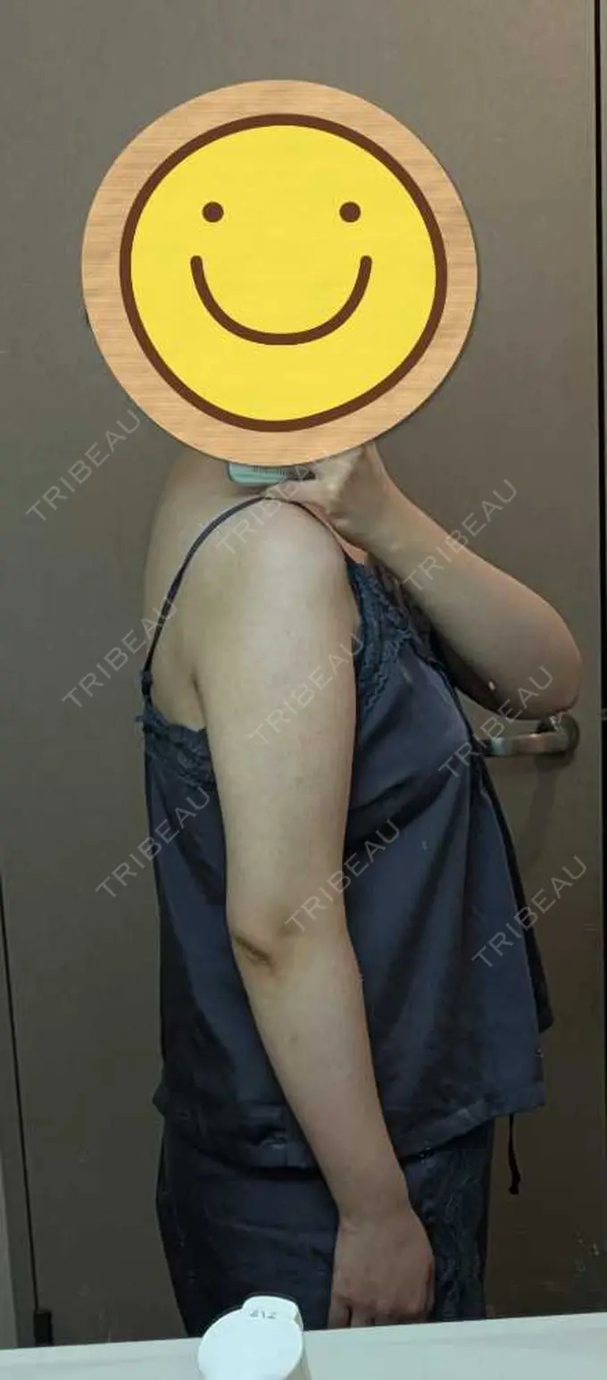 脂肪吸引（二の腕） / 脂肪吸引（肩） / その他 湘南美容クリニック 銀座院 DAY 91 メイン用