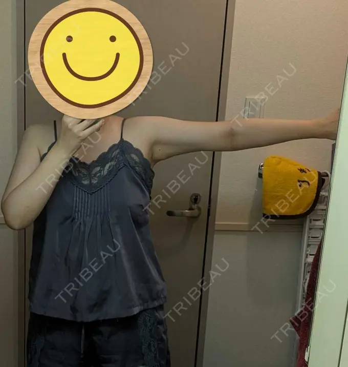 脂肪吸引（二の腕） / 脂肪吸引（肩） / その他 湘南美容クリニック 銀座院 DAY 91 メイン用