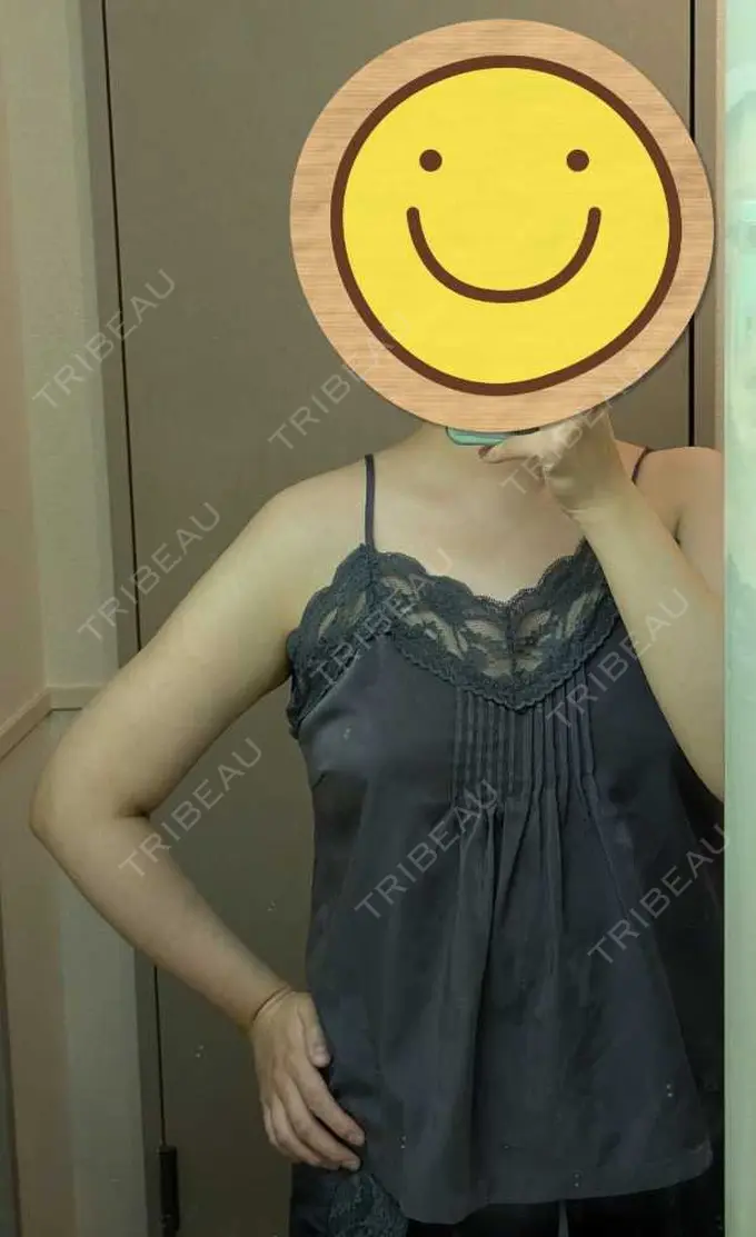 脂肪吸引（二の腕） / 脂肪吸引（肩） / その他 湘南美容クリニック 銀座院 DAY 91 メイン用