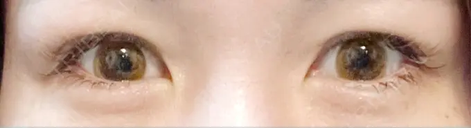 二重埋没 / 上まぶたの脂肪取り 恵聖会クリニック 梅田院 DAY 30 メイン用