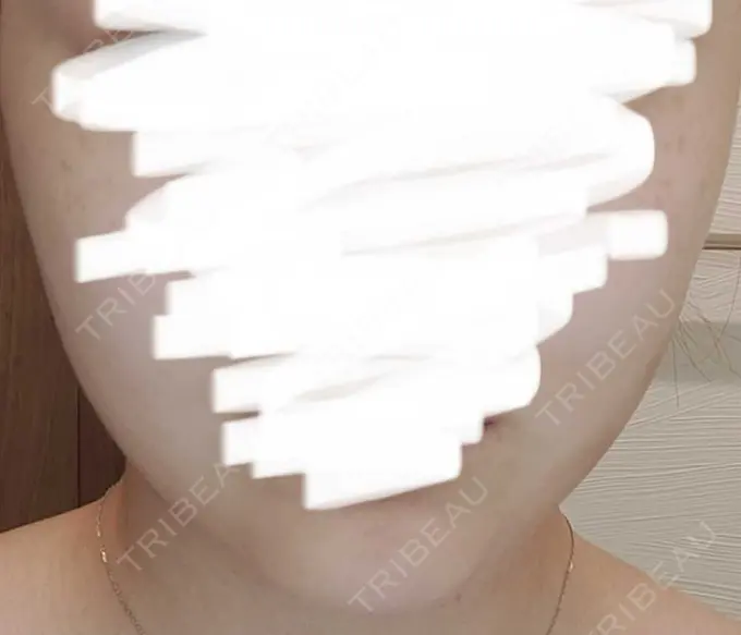 脂肪吸引注射（顔） 東京シンデレラ美容外科 池袋院 DAY 1 メイン用