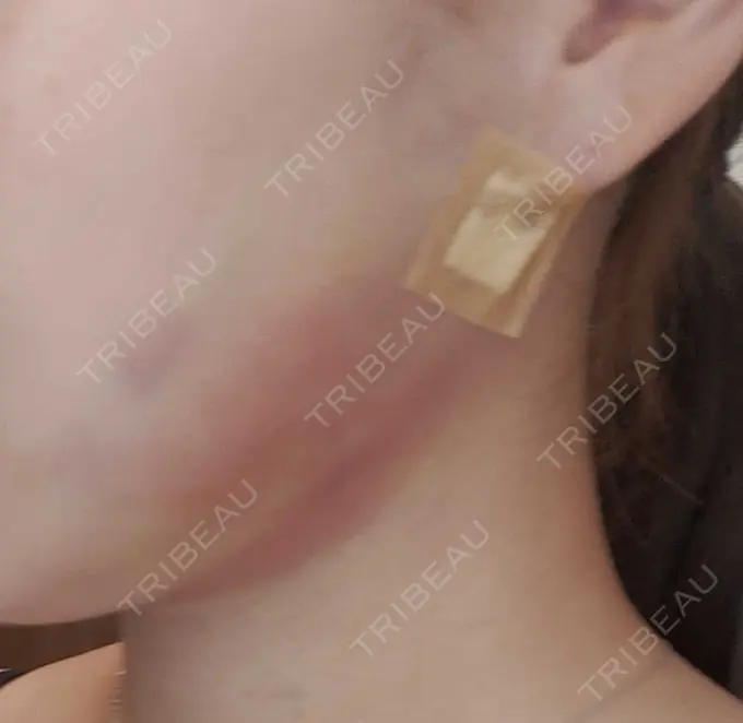 脂肪吸引注射（顔） 東京シンデレラ美容外科 池袋院 DAY 1 メイン用