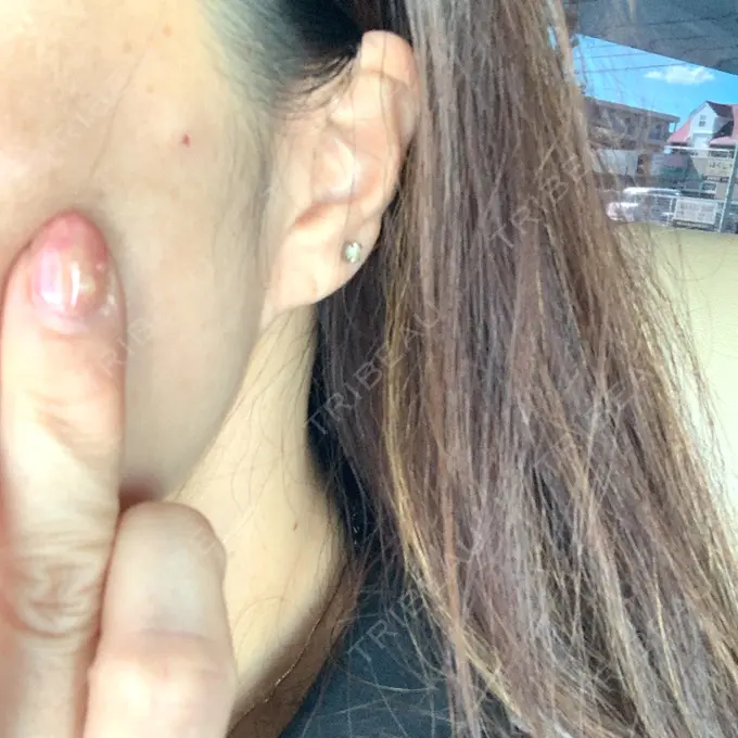 糸リフト / ヒアルロン酸注入（頬） ネビュラクリニック 京都院 DAY 2 メイン用