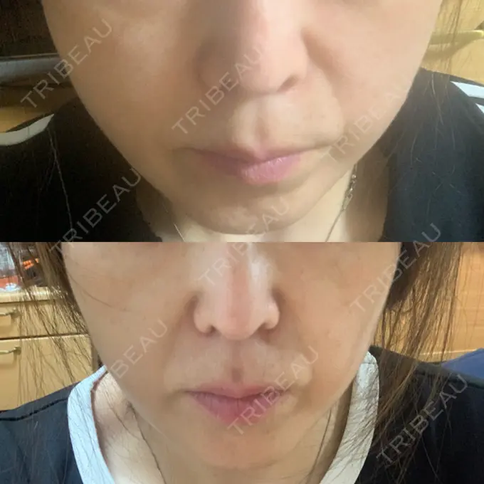 糸リフト / ヒアルロン酸注入（頬） ネビュラクリニック 京都院 DAY 2 メイン用