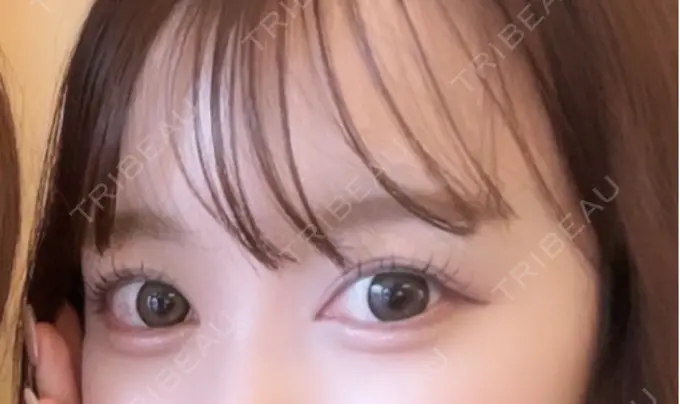 目頭切開 AI Beauty Clinic （エーアイ美容クリニック） AFTER メイン用