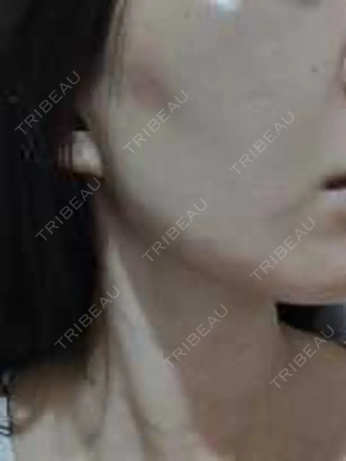 ピーリング（ニキビ・毛穴） 豊洲内科・糖尿病 / 形成・美容外科クリニック AFTER メイン用