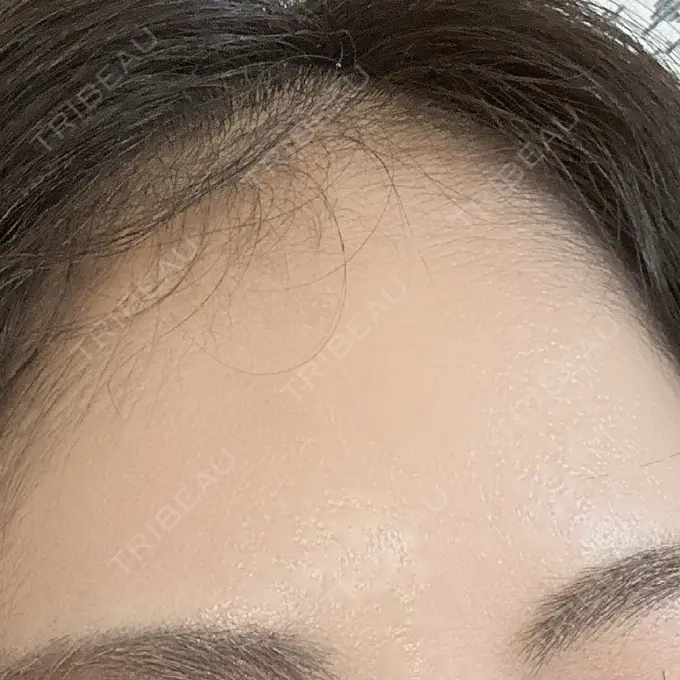 肌ヒアルロン酸注入（たるみ・シワ改善） / ヒアルロン酸注入（額） ROOTS Clinic AFTER メイン用