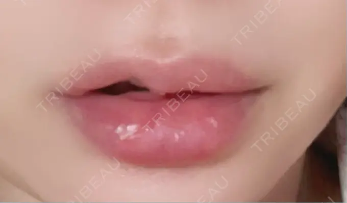 ヒアルロン酸注入（唇） / ボトックス（口角） L‘amour clinic Tokyo【ラムールクリニック東京】 DAY 2 メイン用