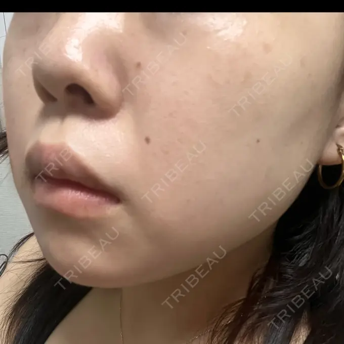 エレクトロポレーション / ルメッカ B-LINE CLINIC 池袋院 AFTER メイン用