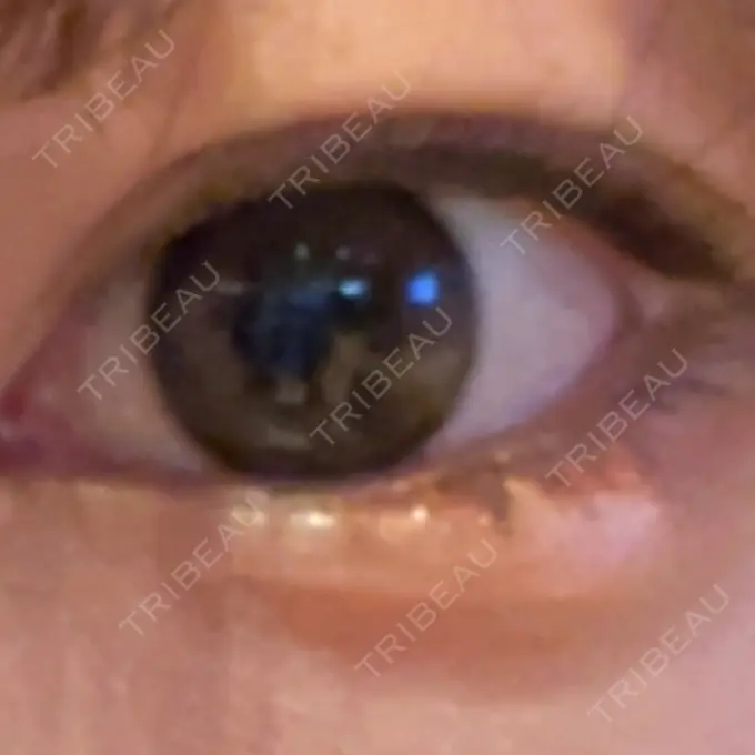 ヒアルロン酸注入（涙袋） フィラークリニック 福岡院 AFTER メイン用