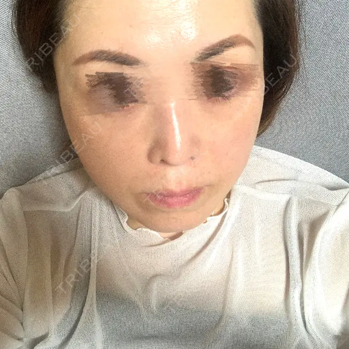 糸リフト / ヒアルロン酸注入（頬） ネビュラクリニック 京都院 DAY 3 メイン用