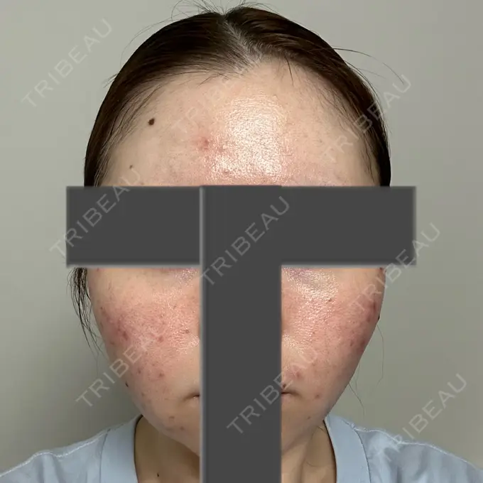 ニードルRF（ポテンツァなど） 東京美容外科 池袋院 DAY 3 メイン用