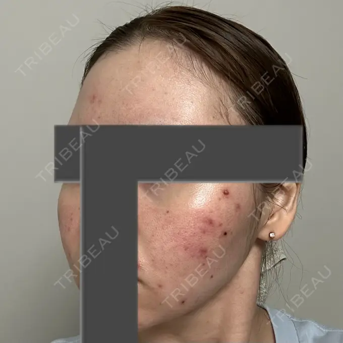 ニードルRF（ポテンツァなど） 東京美容外科 池袋院 DAY 3 メイン用