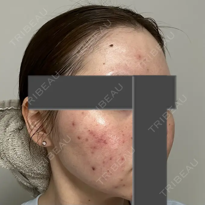 ニードルRF（ポテンツァなど） 東京美容外科 池袋院 DAY 3 メイン用