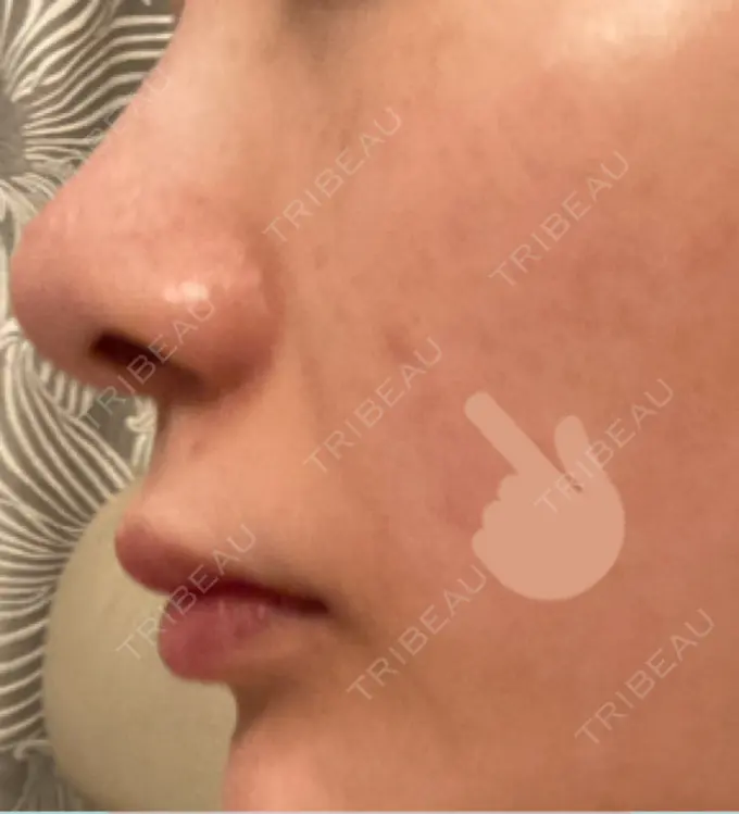 ほくろ・いぼ切除（肌） バログ医院 江南院 DAY 150 メイン用