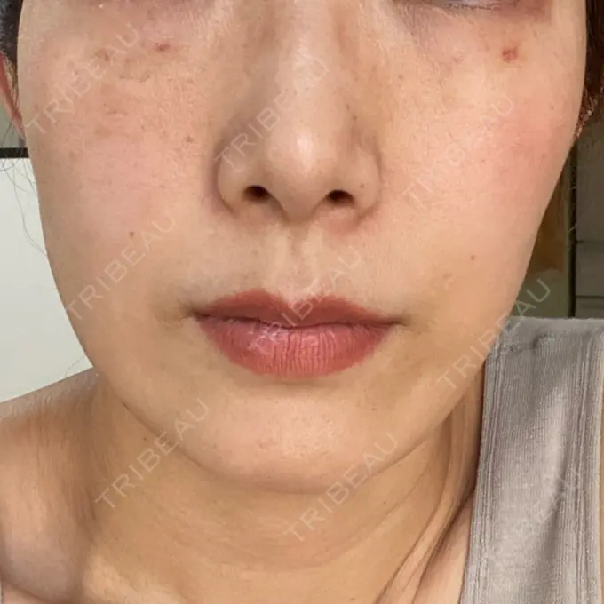 水光注射（ハリ・美肌） オラクル美容皮膚科 名古屋院 DAY 8 メイン用