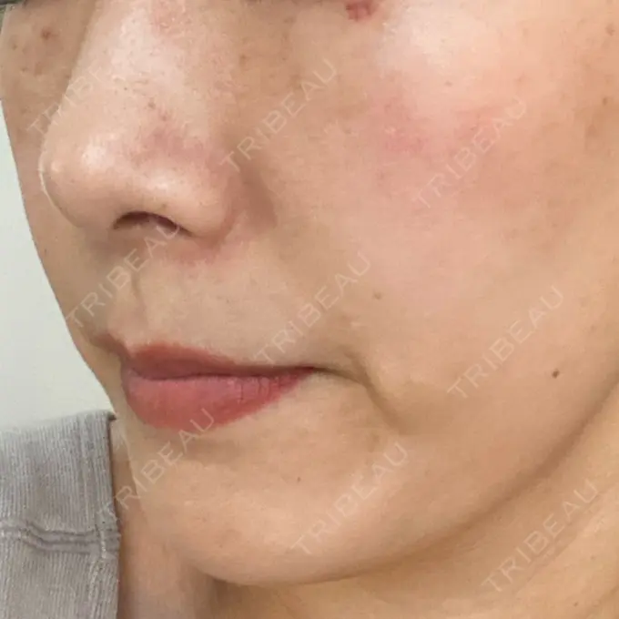 水光注射（ハリ・美肌） オラクル美容皮膚科 名古屋院 DAY 8 メイン用