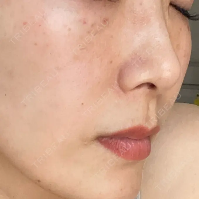 水光注射（ハリ・美肌） オラクル美容皮膚科 名古屋院 DAY 8 メイン用