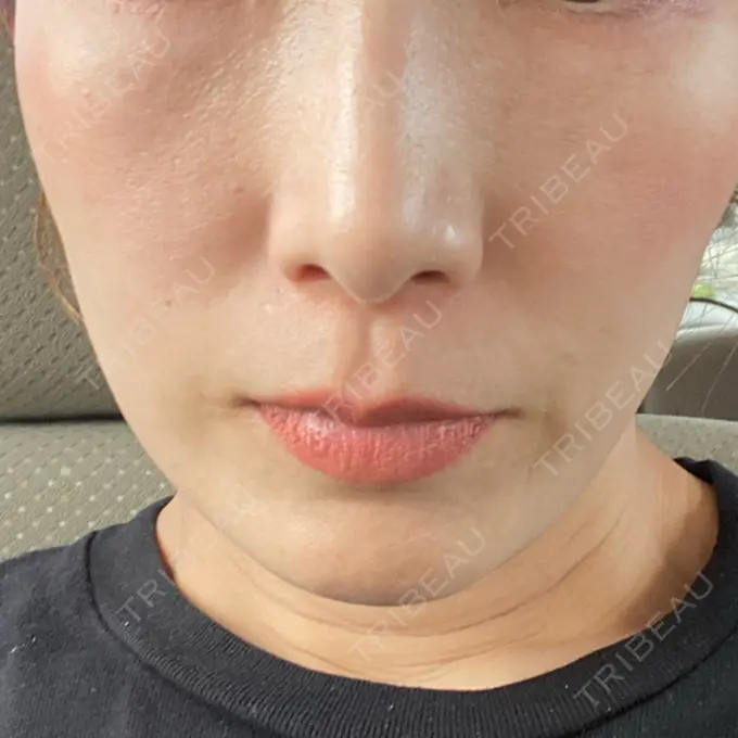 水光注射（ハリ・美肌） オラクル美容皮膚科 名古屋院 DAY 12 メイン用