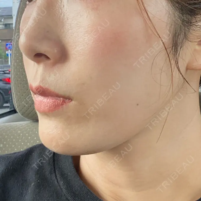 水光注射（ハリ・美肌） オラクル美容皮膚科 名古屋院 DAY 12 メイン用