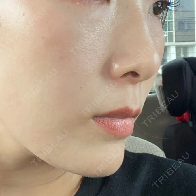 水光注射（ハリ・美肌） オラクル美容皮膚科 名古屋院 DAY 12 メイン用