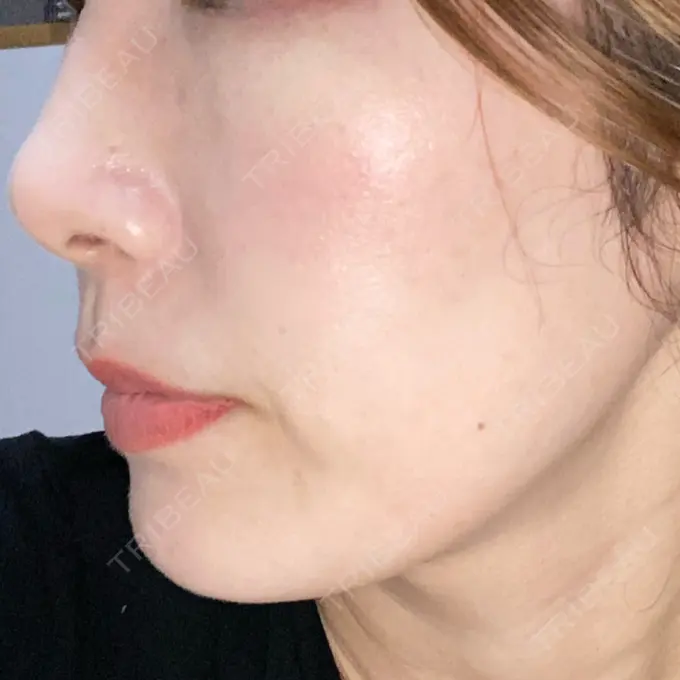 水光注射（ハリ・美肌） オラクル美容皮膚科 名古屋院 DAY 13 メイン用