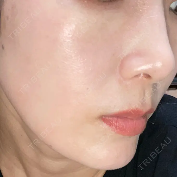 水光注射（ハリ・美肌） オラクル美容皮膚科 名古屋院 DAY 13 メイン用