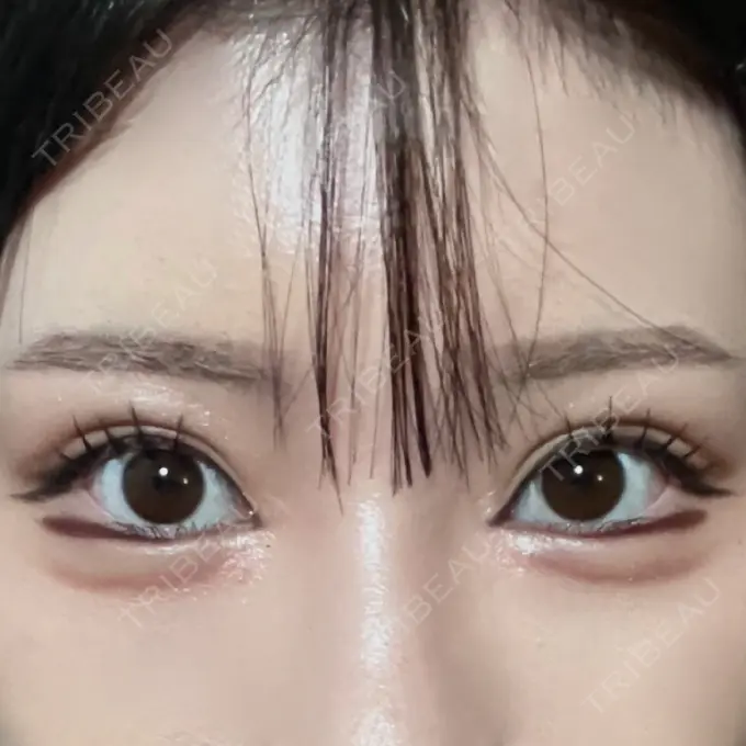 二重埋没 / 目頭切開 / 自然癒着法 AI Beauty Clinic （エーアイ美容クリニック） AFTER メイン用