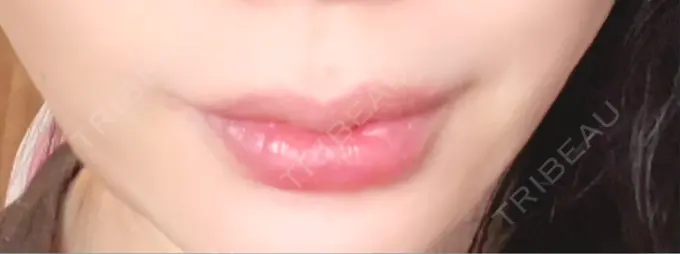 ヒアルロン酸注入（唇） / ボトックス（口角） L‘amour clinic Tokyo【ラムールクリニック東京】 DAY 3 メイン用