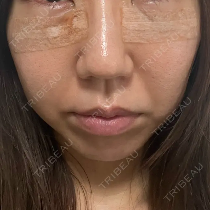 クマ治療 吉井クリニック DAY 2 メイン用